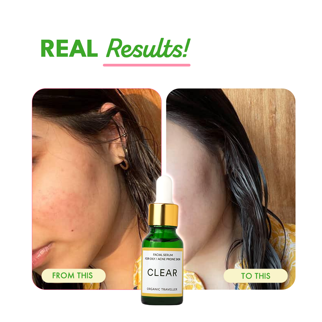 Clear: Acne clearing serum