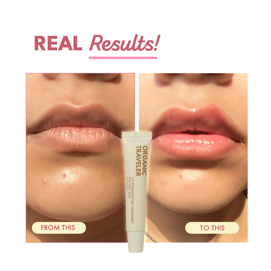 Lip Pigmentation Treatment
