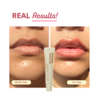 Lip Pigmentation Treatment