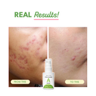 Acne Calming Serum